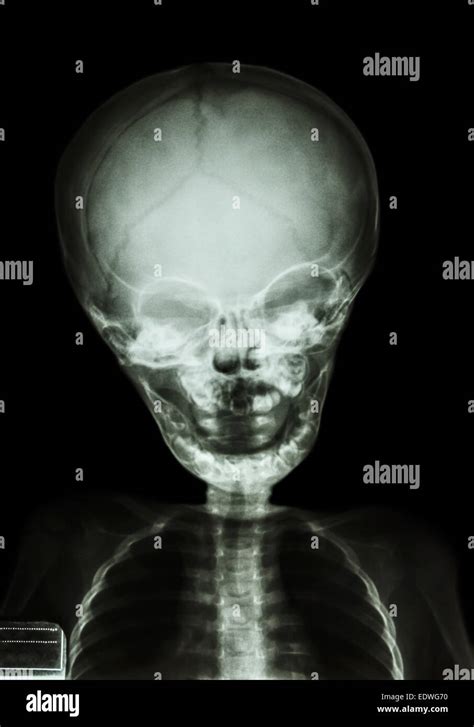 film x-ray skull and body of child Stock Photo - Alamy