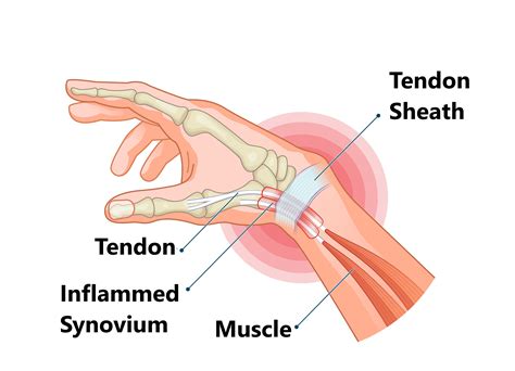 De Quervain's Tenosynovitis - My Family Physio