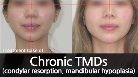 Chronic TMDs / condylar resorption / mandibular hypoplasia / 만성 턱관절장애 ...