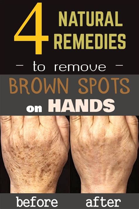 4 natural remedies to remove brown spots on hands | Cilt bakımı, Sağlık