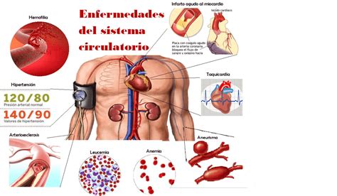 ENFERMEDADES DEL SISTEMA CIRCULATORIO | Quizizz