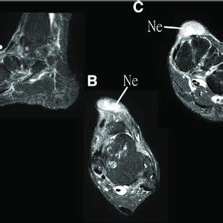 Magnetic resonance images of the illustrated case show a neurilemmoma ...