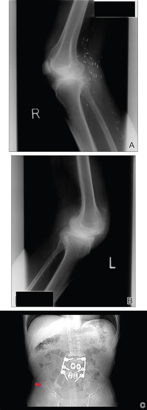 Nail-Patella Syndrome: Clinical Clues for Making the Diagnosis | MDedge Dermatology