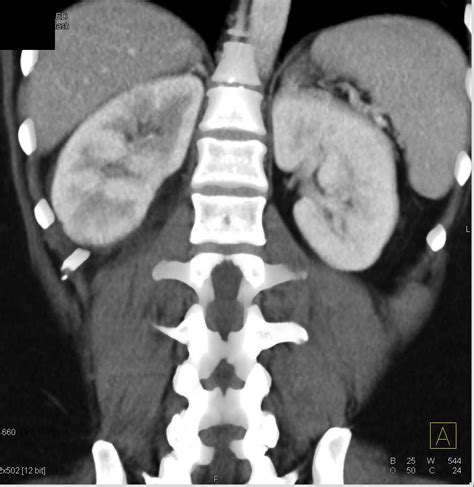 Acute Pyelonephritis Right Kidney - Kidney Case Studies - CTisus CT Scanning