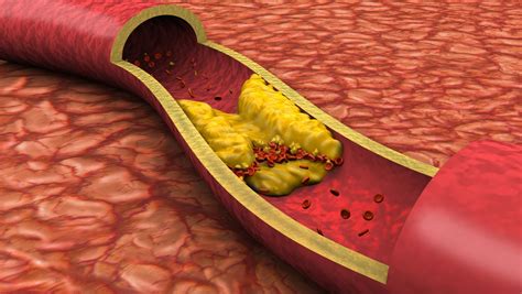 Nanoparticles Use Force to Destroy Tumors