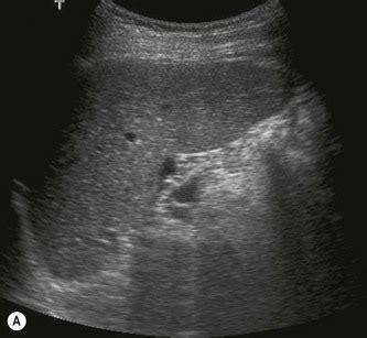 Ultrasound of the spleen and lymphatic system | Radiology Key