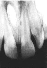 Intra oral periapical radiograph showing the location of mesiodens. | Download Scientific Diagram