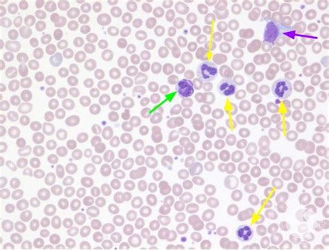 A Normal Peripheral Blood Smear Download Scientific D - vrogue.co