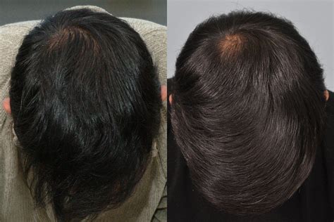 Minoxidil (Regaine) & FDA Medicine results after 10 years