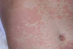 ASK DIS: Maculopapular Rash : Diagnosis