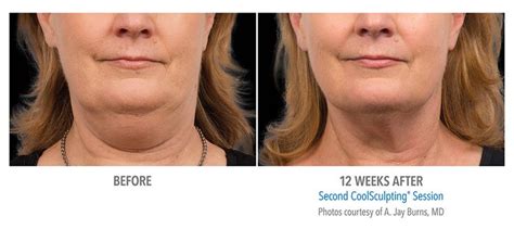 Top Treatments for Double Chin & Neck Rejuvenation in Beverly Hills | Cool sculpting, Chin ...