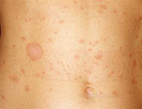 archeruyxu - pityriasis rosea photos symptoms