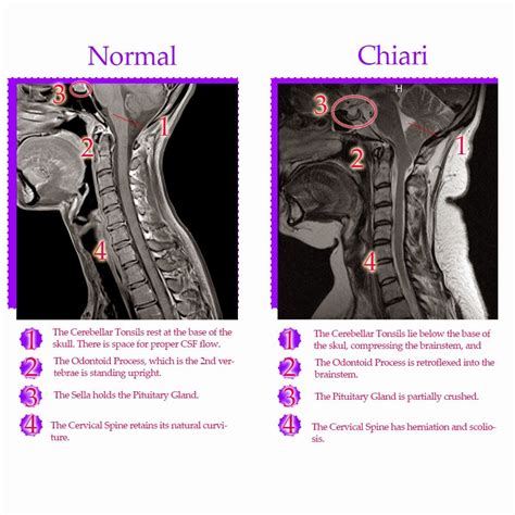 normal brain mri vs retroflexed odontoid - Google Search | Chiari | Pinterest | Brain, Chiari ...