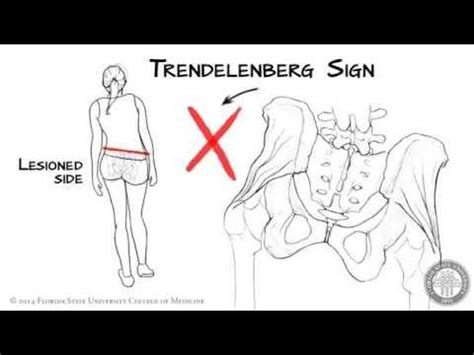 Trendelenburg gait - what it is, what causes it and what to focus on in ...