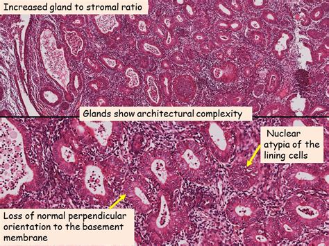 Pathology of Endometrial Hyperplasia - Pathology Made Simple