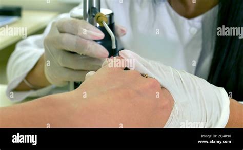 Wart skin removal Stock Videos & Footage - HD and 4K Video Clips - Alamy