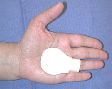 Metacarpophalangeal joint blocking splint to treat a trigger finger.... | Download Scientific ...