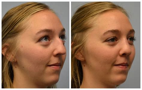 Atlanta Septoplasty & Rhinoplasty Before and After Photos