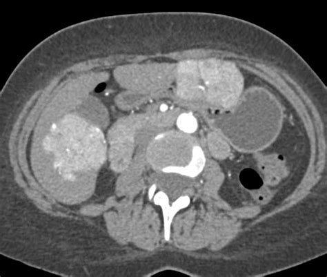 Multiple Focal Nodular Hyperplasia in the Liver (FNH) - Liver Case Studies - CTisus CT Scanning