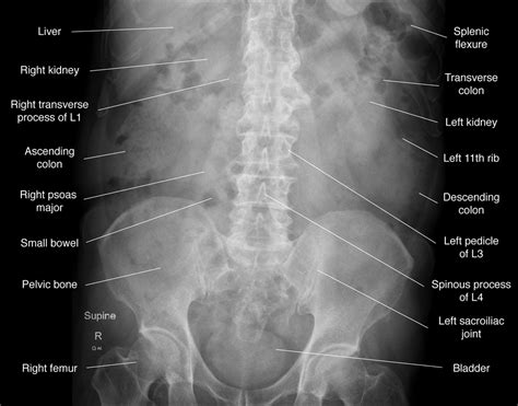 Pelvis X Ray Anatomy