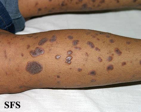 Lichen Planus (Skin, Mouth) Causes, Pictures and Treatment | Healthhype.com