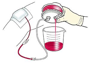 Discharge Instructions: Caring for Your Hemovac Drainage Tube | Saint ...