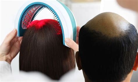 Hair loss treatment: Alopecia may be treated with low level laser therapy | Express.co.uk
