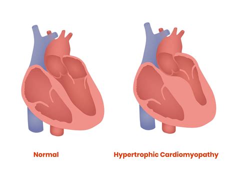 Hypertrophic Obstructive Cardiomyopathy & The Treatments