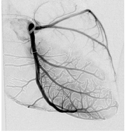 Coronary angiogram with an arterial ROI superimposed over the LAD ...