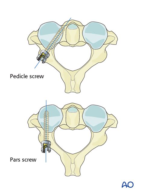 C2 pedicle screw insertion