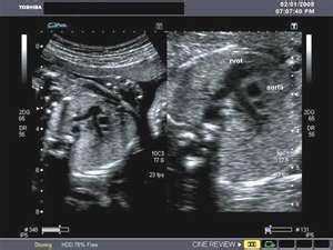 Fetal Heart RVOT | Ultrasound, Diagnostic medical sonography, Cardiac sonography