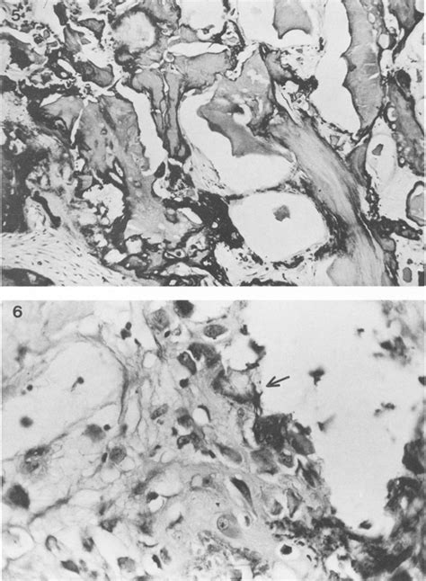 Metaplastic bone formation seen replacing the fibrous septae in one of... | Download Scientific ...