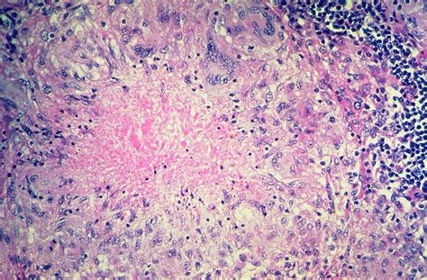 Pulmonary tuberculosis - Necrotizing granuloma | Flickr - Photo Sharing!