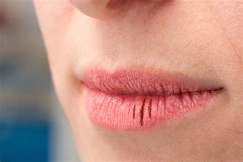 Understanding Dry Mouth: 10 Symptoms to Look Out For - Facty Health