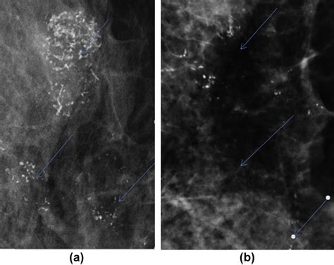 Does change in microcalcifications with neoadjuvant treatment correlate with pathological tumour ...