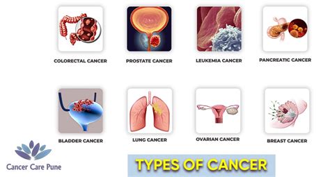 Types Of Cancer - Dr. Jagdish Shinde