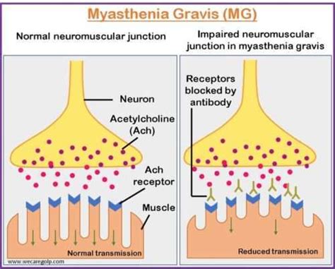 Myasthenia Gravis (MG): Symptoms, Management - We Care