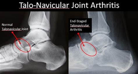 Rheumatoid Arthritis - Talonavicular Joint - FootEducation