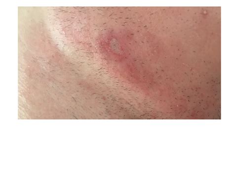 Is this an infected scab !? - General acne discussion - Acne.org