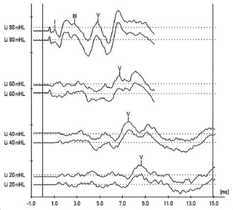 Corrected peaks of auditory brainstem response waveforms for the left ...