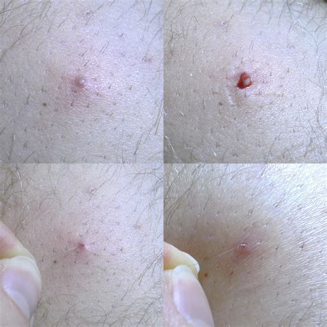 Common nowadays disease: ingrown hair