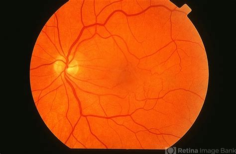 Macular Pucker - Retina Image Bank