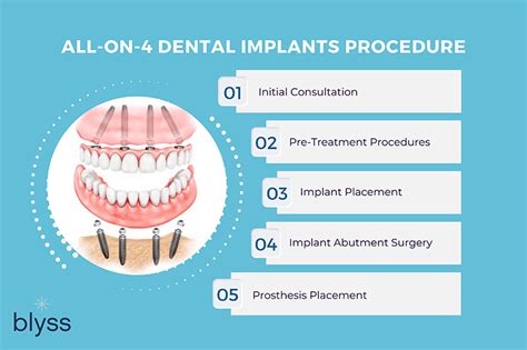 All-on-4 Dental Implants: Top 8 Factors to Consider Before Getting Them