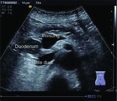 Pancreatic Duct Ultrasound
