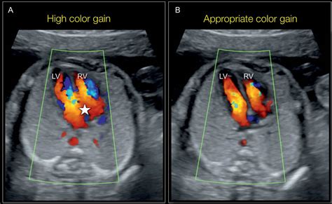 Color Doppler in Fetal Echocardiography | Obgyn Key