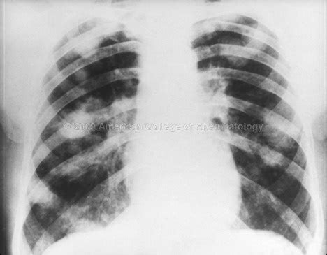 Caplan’s syndrome (RA + pneumoconiosis) - many of the patients are coal miners | Rheumatoid ...