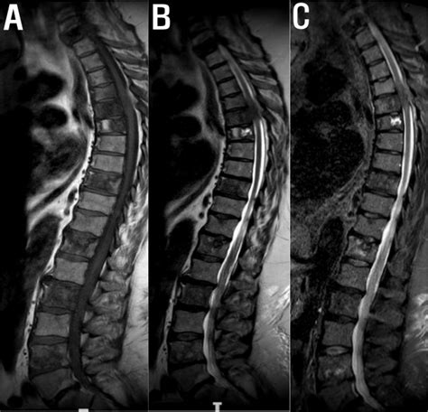 Mri Images Spine