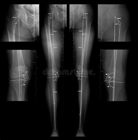 Measure Leg Length Discrepancy