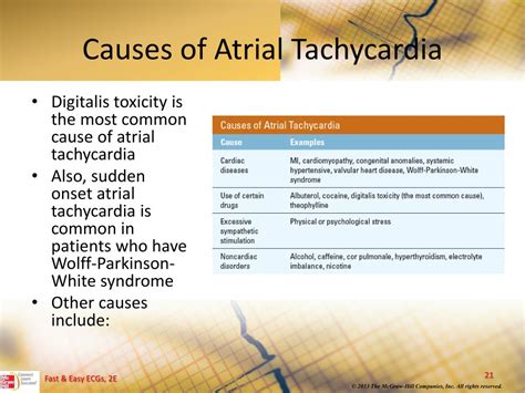 PPT - Atrial Dysrhythmias PowerPoint Presentation, free download - ID:5660215