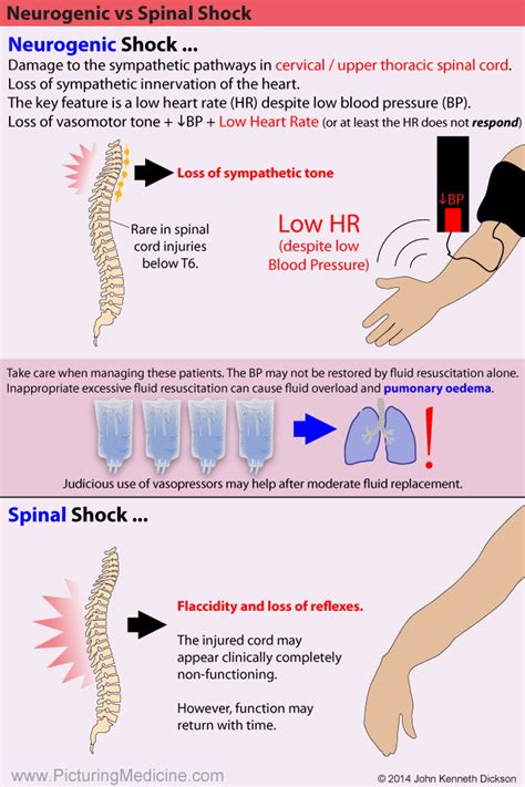 Neurogenic Vs Spinal Shock - Spinal shock / Between spinal and ...